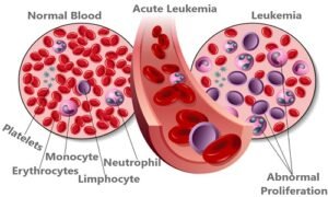Acute Leukemia