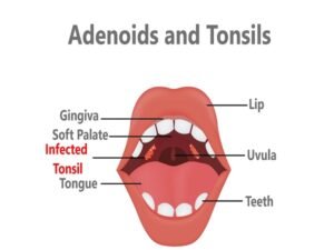 Adenoids and Tonsils