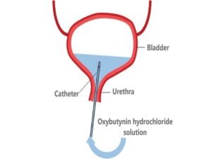 Bladder Instillation