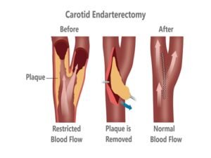 Carotid Endarterectomy