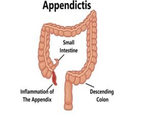 Appendictis