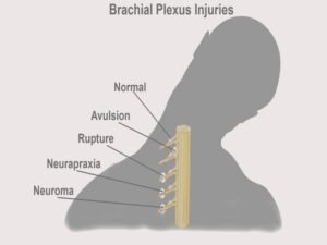 Brachial Plexus Injuries